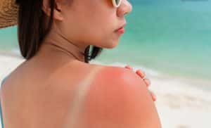 Sunburn—How-To-Recog
